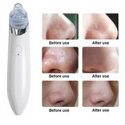 Blackhead Remover Vacuum Acne Cleaner – Deep Pore Cleansing for Flawless Skin